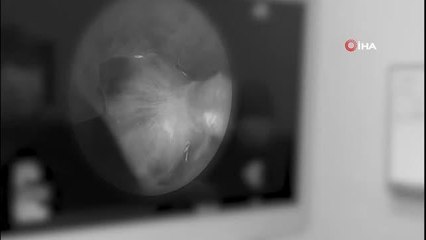 Nefes alamayan KOAH hastalarını koşturan tedavi: Rezektör balon tedavisi