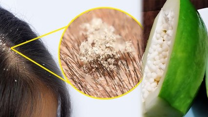 कच्चे पपीते से डैंड्रफ हटाने का आसान तरीका | Kacha Papita Se Dandruff Kese Hateye | Boldsky