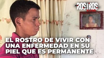 El rostro de vivir con una enfermedad en su piel que es permanente - Rostros de la Crisis