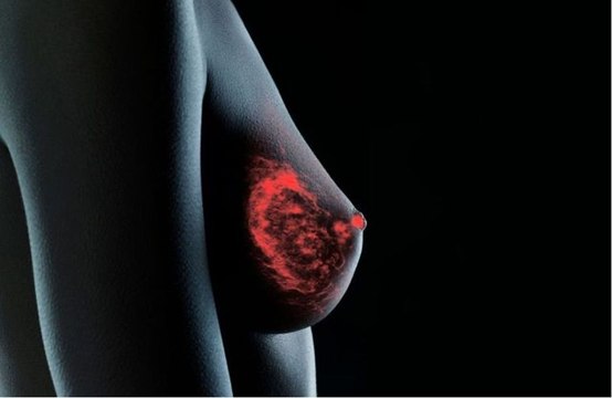 Cancer du sein : quels sont les premiers symptômes qui doivent vous inquiéter ?