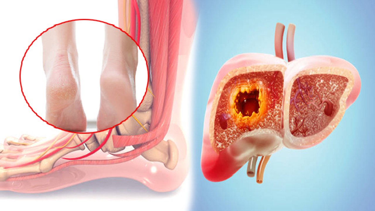 चलने में परेशानी होना Fatty Liver Symptoms, क्या है Reason |Boldsky