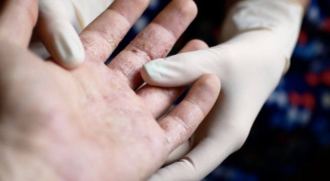 Psoriatic Arthritis Symptoms