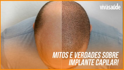 MITOS E VERDADES SOBRE O TRANSPLANTE CAPILAR