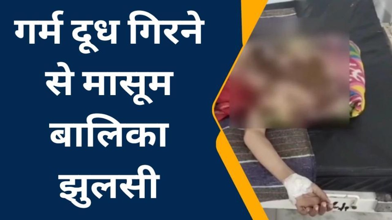भीलवाड़ा: गर्म दूध गिरने से मासूम बालिका झुलसी, जिला अस्‍पताल में करवाया भर्ती