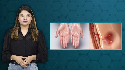 हाथ में पसीना आना Cancer का खतरा , हाथ में पसीना आने का कारण और बीमारी | Boldsky