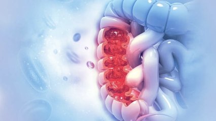 5 Formas De Reducir El Riesgo De Cáncer De Colon