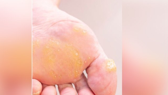 पैरों में छाले क्यों होते है । पैरों में छाले होना Callus Symptoms और Reason चौकाने वाले । Boldsky