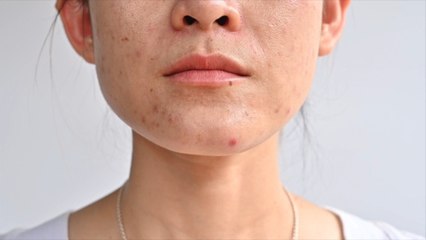 3 Types of Acne Scars—and the Best Treatments for Each
