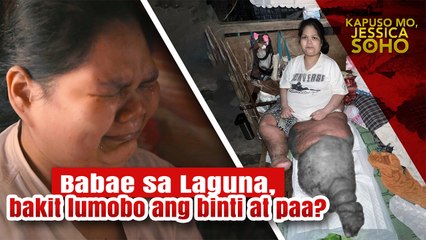 Babae sa Laguna, lumobo ang kaliwang binti at paa | Kapuso Mo, Jessica Soho