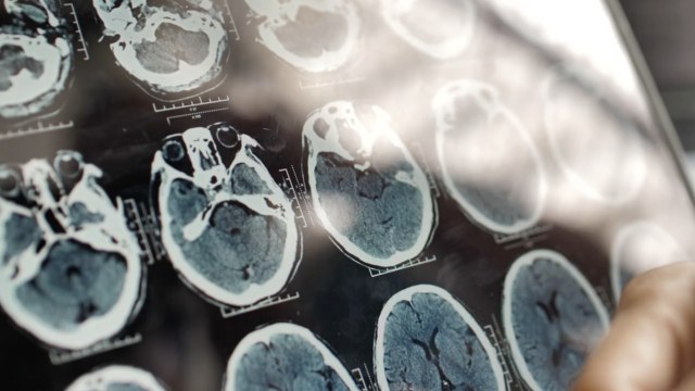 How Does Alcohol Affect Your Brain Health?