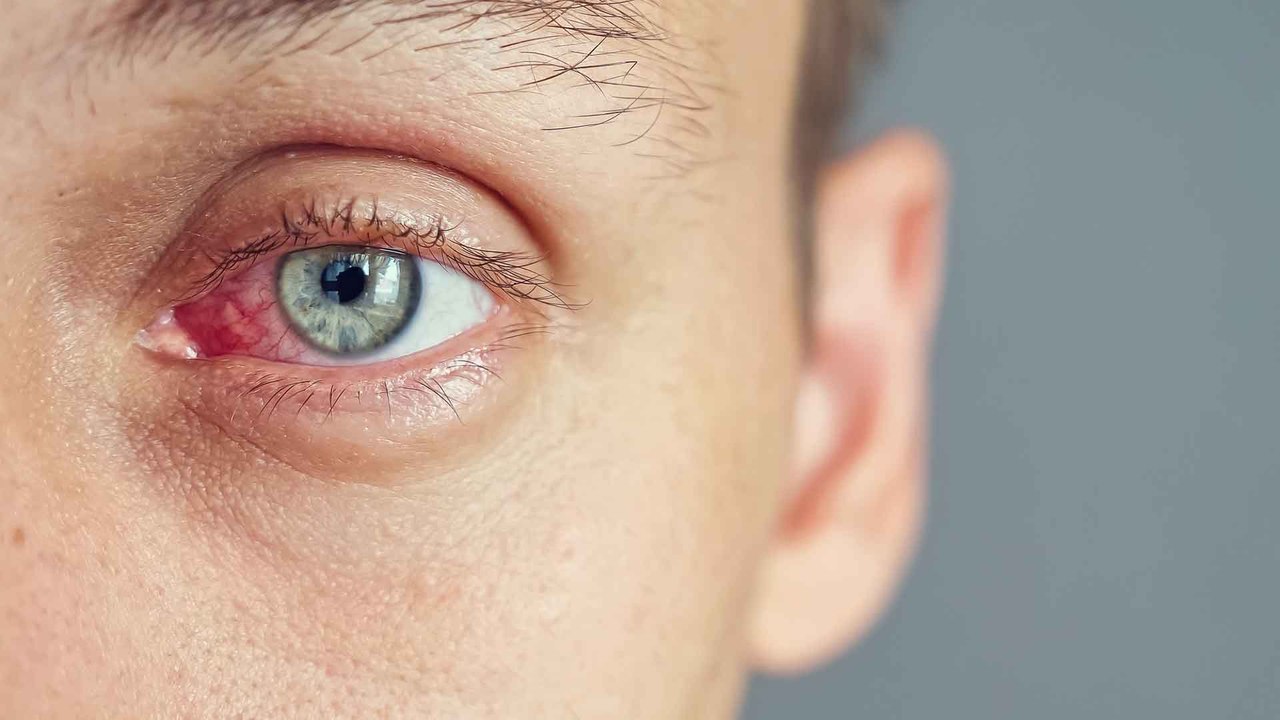 Brennende Augen: Das sind die Ursachen