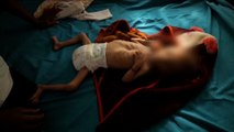 اليمن.. تجربة عيادة تعمل على إنقاذ أطفال مصابين بسوء التغذية