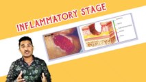 Inflammatory Stage । घाव को जल्दी कैसे ठीक करें। जख्म को जल्दी कैसे भरें । घाव का इलाज।