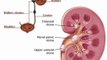 kidney stones causes and homeopathic treatment