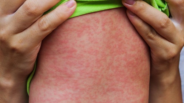 Bilim Kurulu üyesinden İstanbul için kızamık uyarısı: Vaka sayısında artış var