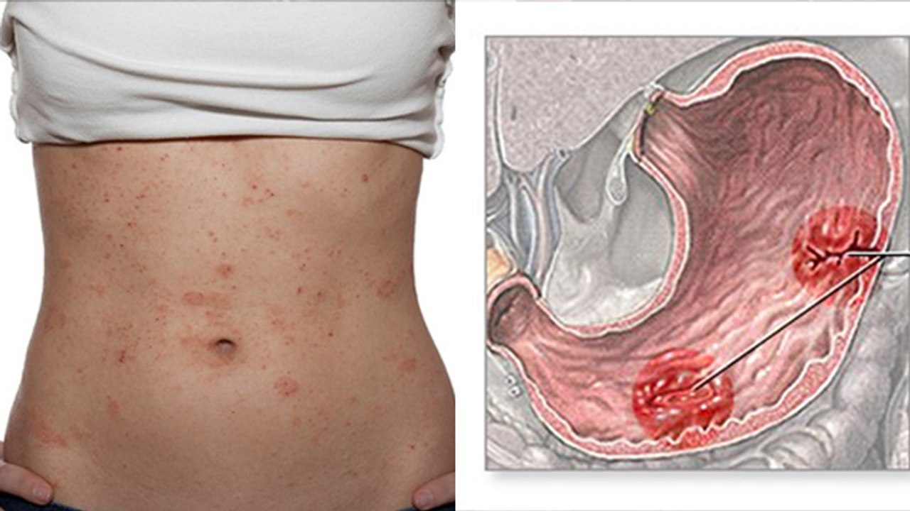 पेट पर दाने क्यों होते है Pet Par Dane Kyon Hote Hain Pet Par Dane