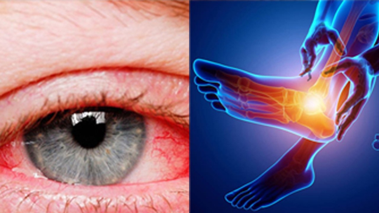 Multiple Sclerosis क्या होता है ? Multiple Sclerosis Symptoms और Reason । Boldsky