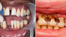 दांत खराब होने का कारण | दांत खराब क्यों होते हैं | Teeth Kyu Kharab Hota hai | Boldsky