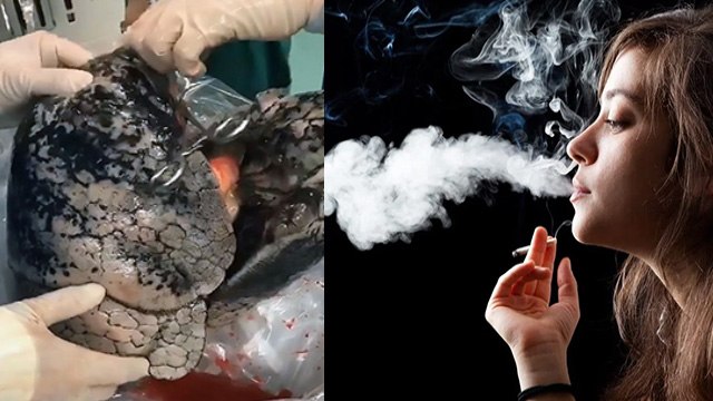 Bullous Disease क्या है जिससे खोखले हो जाते है फेफड़े | Bullous Disease Symptoms | Boldsky