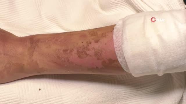 Lavabo açıcı bomba gibi patladı, genç kız: Kolumdan vazgeçmiştim, yüzümden çok korktum