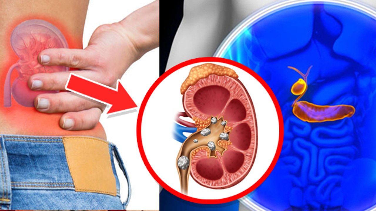 Stomach में ऐसे होना Kidney Stone ya Gallbladder Stone जानें क्या है Symptoms । Boldsky