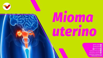 Buena Vibra | Mitos y realidades sobre el mioma o fibroma uterino