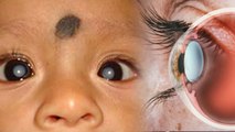 बच्चों में मोतियाबिंद कैसे, White Cataract Symptoms और Reason, क्या है Treatment | Boldsky