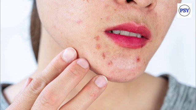 Say Goodbye to Pimples: Expert Tips on How to Prevent Them