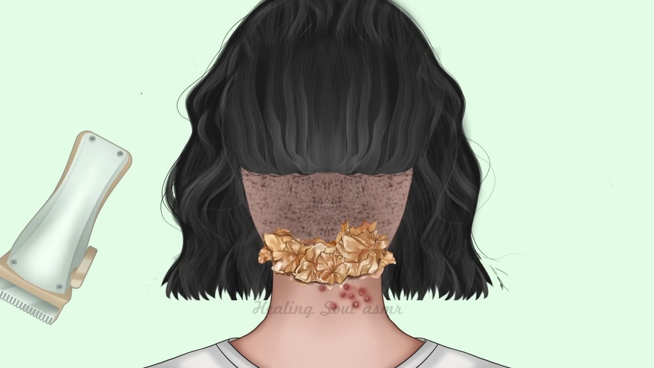 ASMR Giant hardened flakes dandruff removal at hairline | Scalp treatment animation