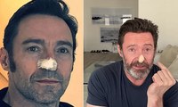 Hugh Jackman di Wolverine e il tumore alla pelle