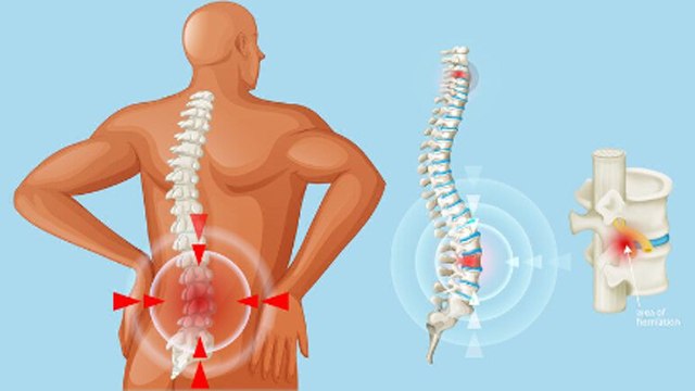 Bulging Disc Kya Hota Hai | बल्जिंग डिस्क क्या है | Bulging Disc Symptom |Reason|Boldsky