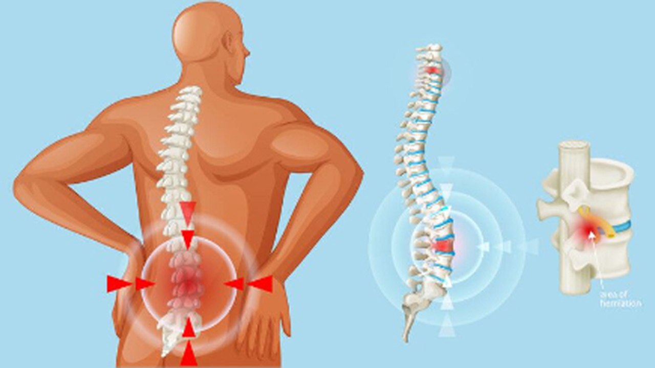 Bulging Disc Kya Hota Hai | बल्जिंग डिस्क क्या है | Bulging Disc Symptom |Reason|Boldsky