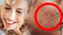 Cold Water Bathing से चेहरे के पिंपल्स को कैसे ठीक करें | Cold Water Acne Treatment | Boldsky