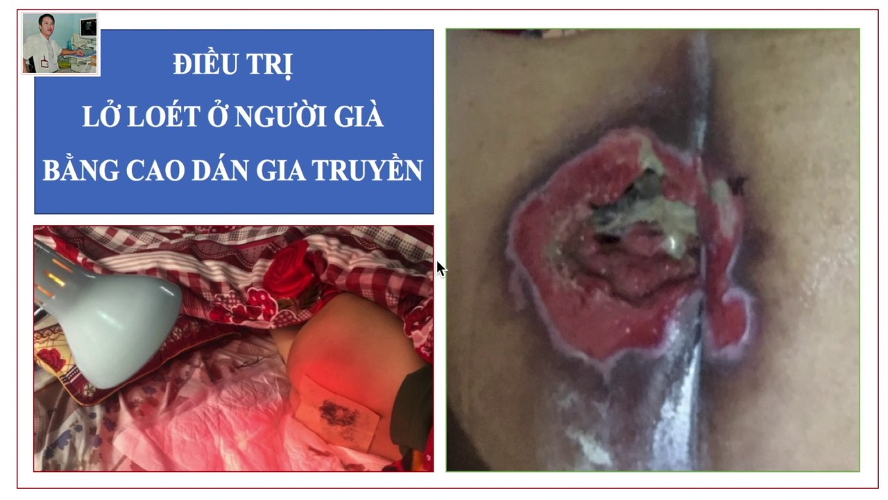 Thuốc chữa lở loét da | Lở loét ngoài da ở người cao tuổi | Người cao tuổi nằm lâu bị loét da