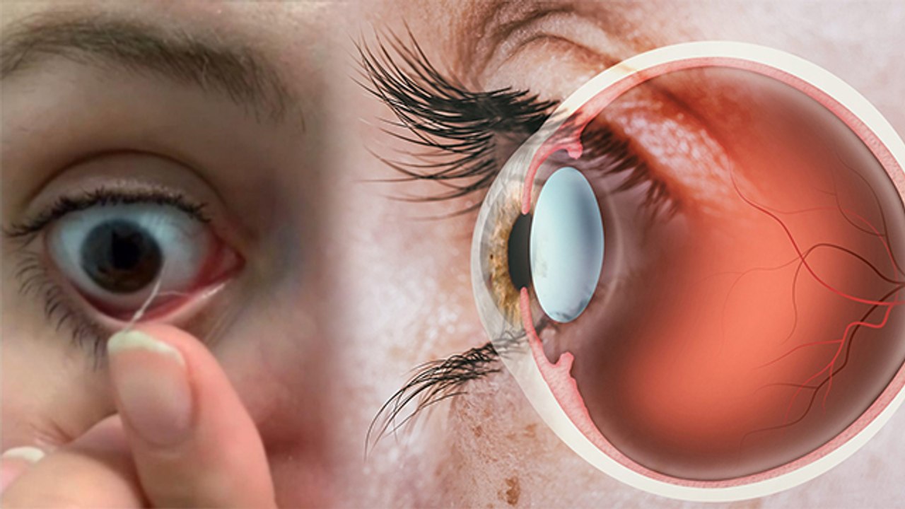 सोकर उठने पर आंखों के किनारे गंदगी क्यों जमती है | Eye Mucus Reason | Eye Discharge Reason | Boldsky