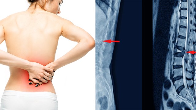 कमर के साइड में दर्द होना | कमर के दोनों साइड में दर्द होना | Kamar Ke Side Me Dard Hona | Boldsky