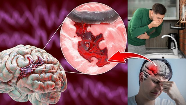 दिमाग की नस ब्लॉक होने के लक्षण | Dimag Ki Nas Kaise Block Hota Hai | Boldsky