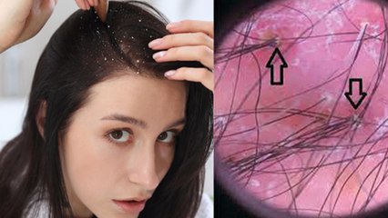 Garmi Me Dandruff Kyu Hota Hai | गर्मी में डैंड्रफ क्यों होता है | Boldsky