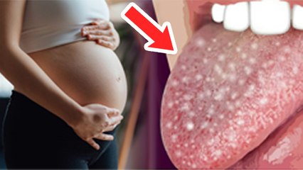 Pregnancy में जीभ में छाले क्यों होते हैं | Pregnancy Me Jeebh Safed Hone Ka Karan | Boldsky