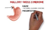 Mallory Weiss Syndrome