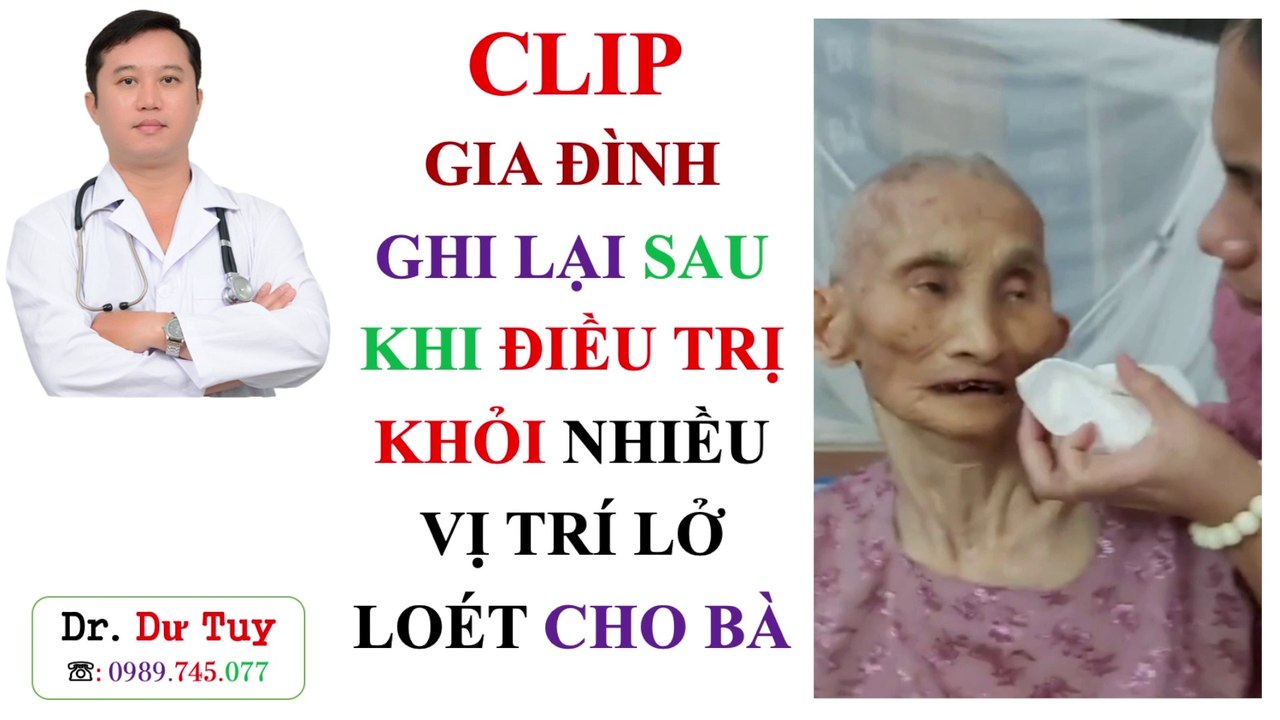 Clip gia đình quay lại sau khi điều trị khỏi nhiều vị trí lở loét trên cơ thể người mẹ được điều trị bằng Cao dán gia truyền
