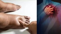 Leg Swelling Heart Attack Symptom कैसे | पैर में सूजन हार्ट अटैक का लक्षण कैसे | Boldsky