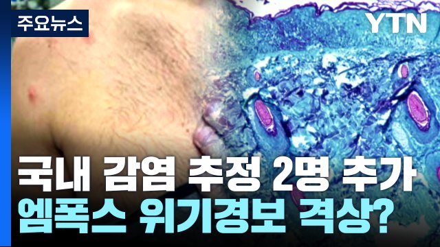 지역사회 감염 추정 엠폭스 환자 2명 추가... 위기경보 격상 논의 / YTN