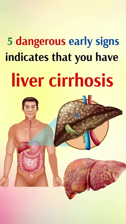 5 Dangerous early signs indicates that you have liver cirrhosis