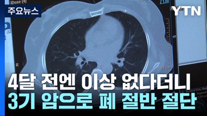 [제보는Y] 넉 달 전엔 이상 없다더니...3기 암으로 폐 절반 절단 / YTN