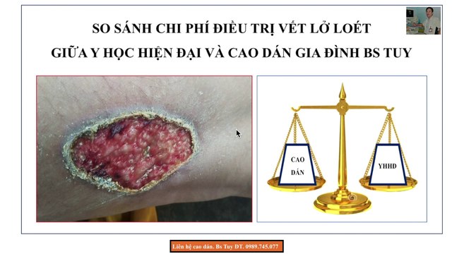 So sánh chi phí điều trị lở loét ngoài da giữa Y học hiện đại và Cao dán gia truyền