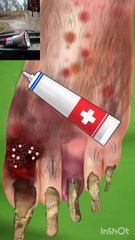 asmr foot cleaning removal athlete's foot treatment animation