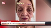 Estetik ameliyat olan 74 yaşındaki kadının değişimi