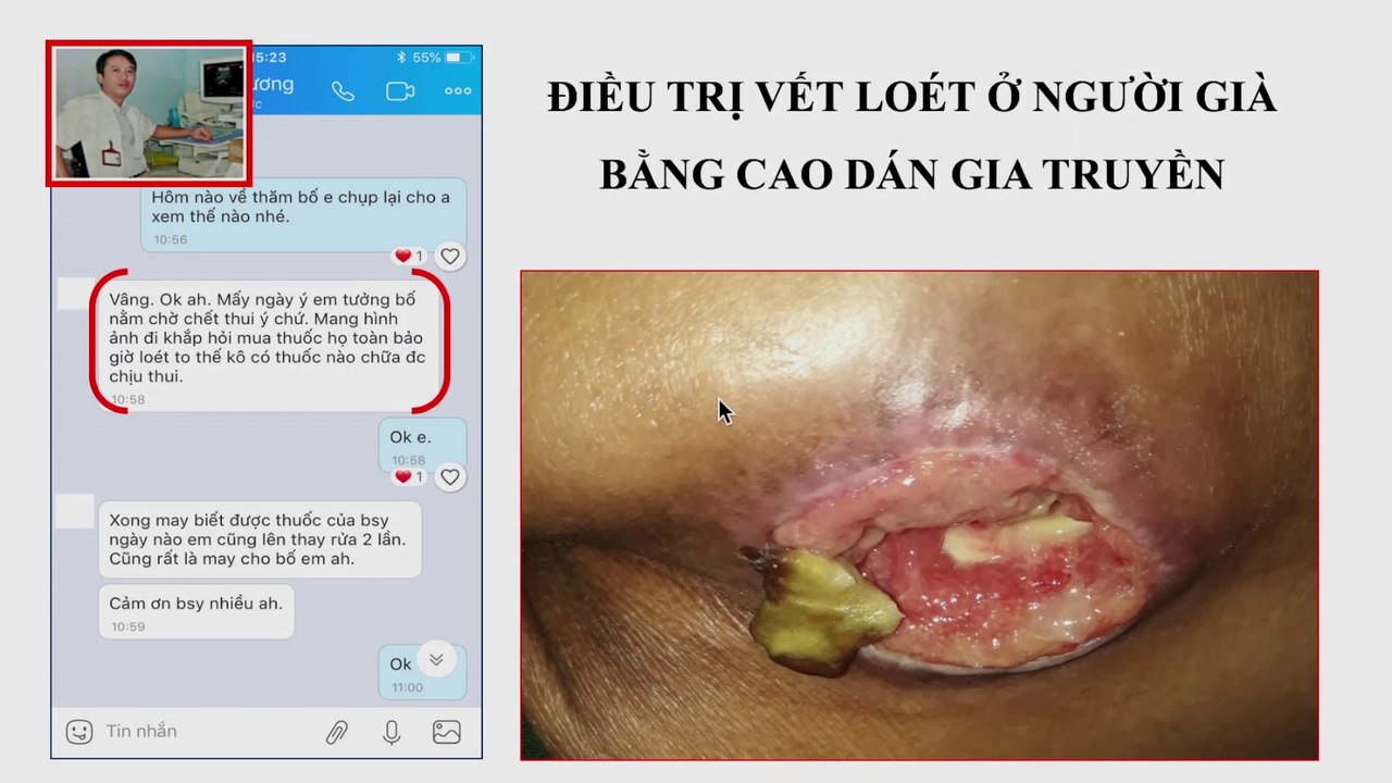 Điều trị vết loét ở người già | Thuốc trị lở loét cho người già | Chữa loét da người già