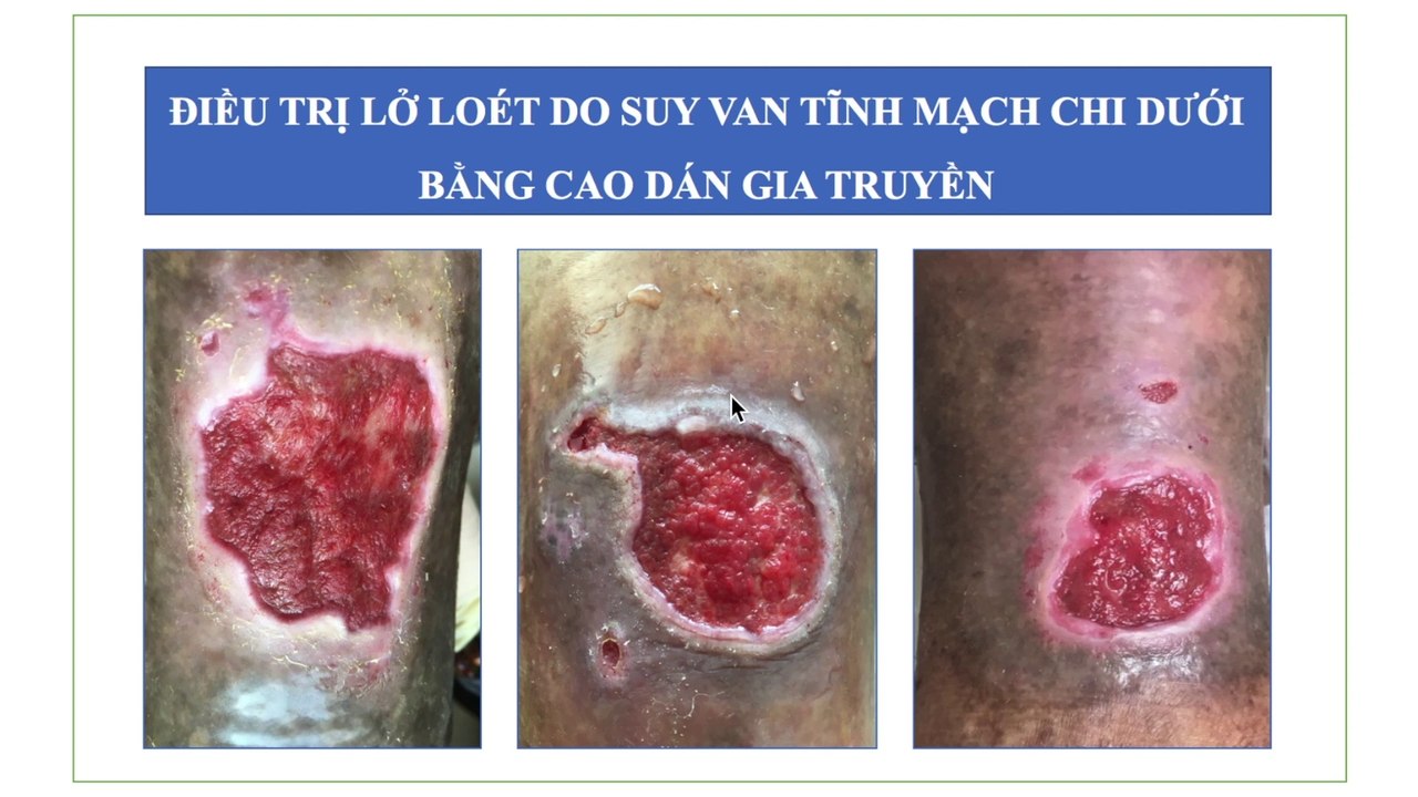 Lở loét chân do suy van tĩnh mạch | Suy van tĩnh mạch dẫn đến lở loét chân | Lở loét bàn chân